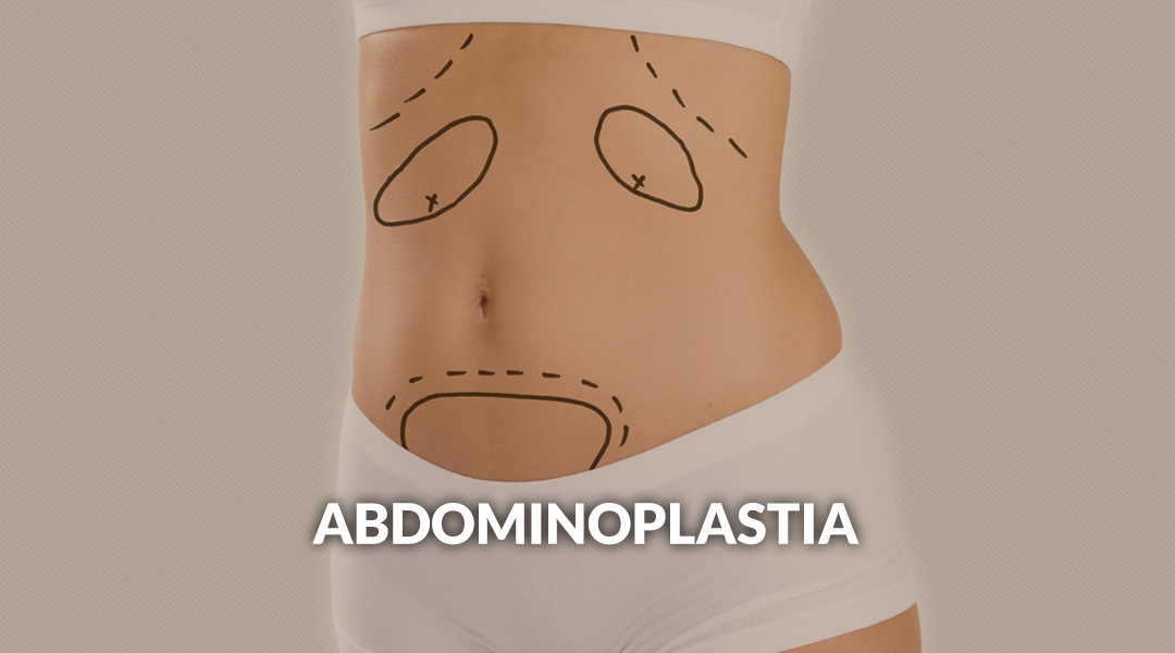 Abdominoplastia